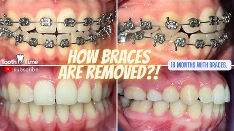 how to remove metal brackets from teeth|how to remove braces from teeth.